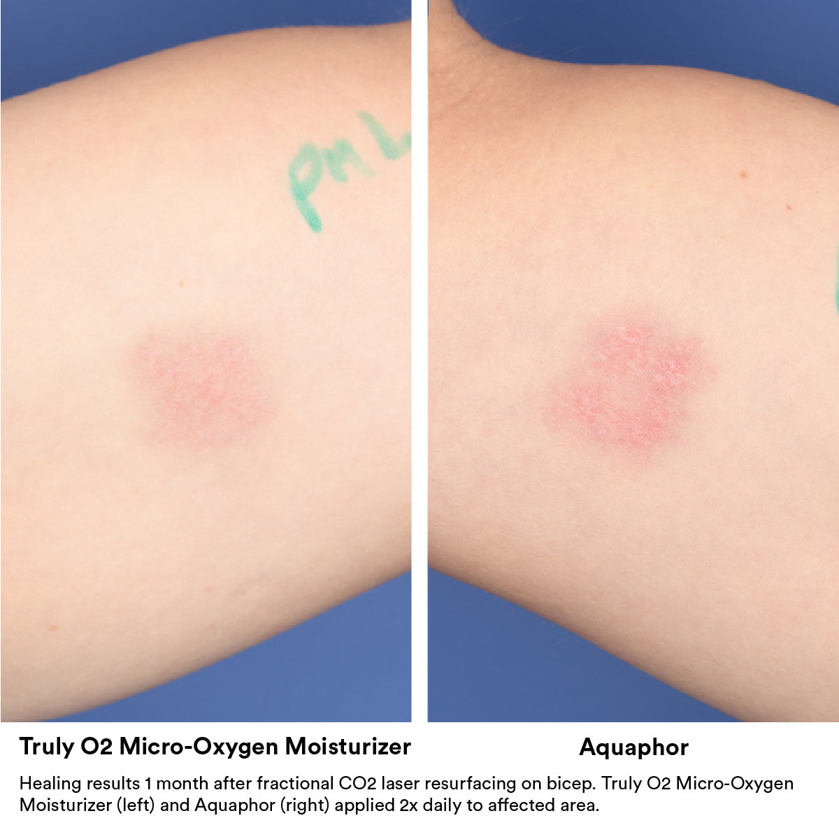 Healing results of CO2 Laser Resurfacing Truly O2 vs Aquaphor